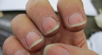 What to do for cracks in the fingers of adults and children?