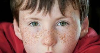 Freckles, what causes them and how to deal with them