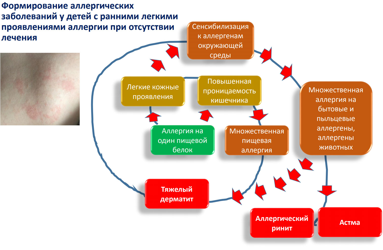 Аллергия возраст. Формы аллергических заболеваний у детей. Проявление пищевой аллергии. Пищевая аллергия признаки. Пищевая аллергическая реакция.