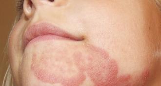 Kaip pasireiškia lygios odos mikozė ir kaip su ja kovoti